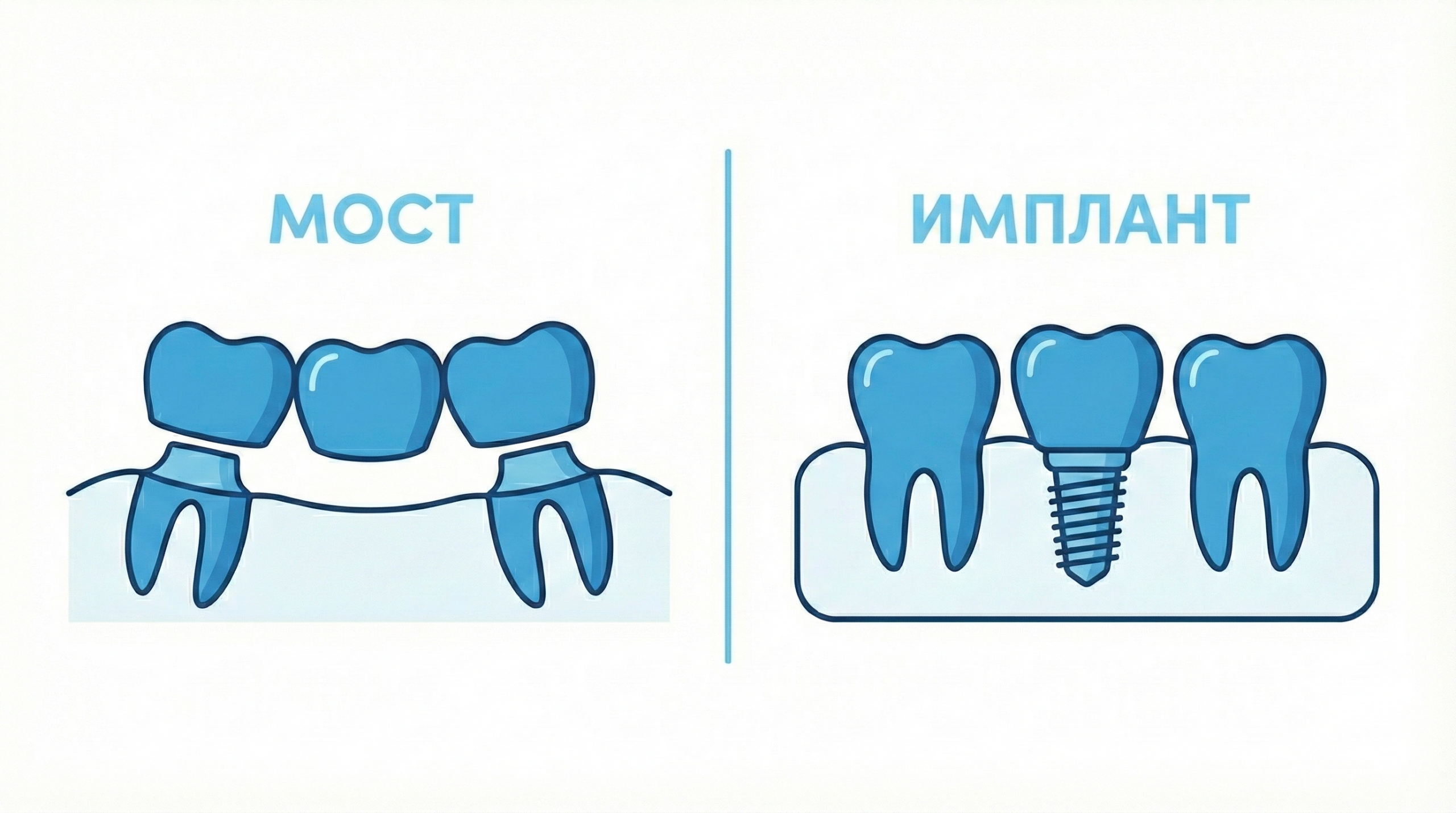 Имплант или мостовидный протез: честное сравнение
